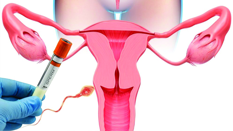 İntrauterin İnseminasyon (Aşılama)